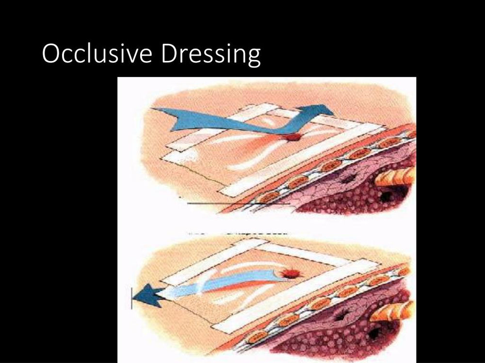 what is an occlusive dressing Flutter Valve (Occlusive Dressing) – Atlantic Medical Supplies cc